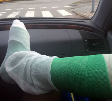 Victoria Joängs gipsade fot sju veckor efter operationen